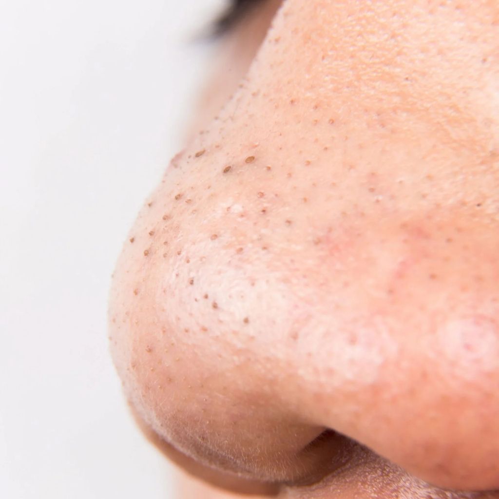 Blackhead suction device with 5 heads