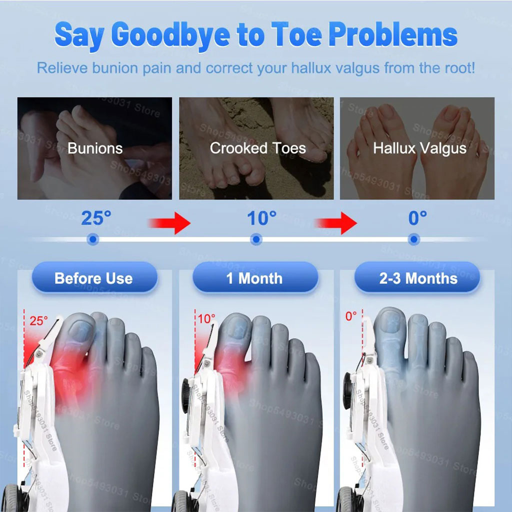 Correcteur d'hallux valgus réglable pour femme et homme